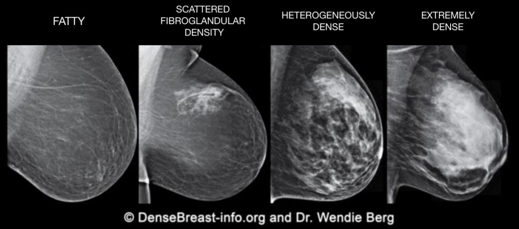 Bilateral mammogram shows mixed density glandular breast tissue with no